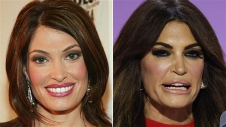 Unmasking The Transformation: What Has Kimberly Guilfoyle Done To Her Face?