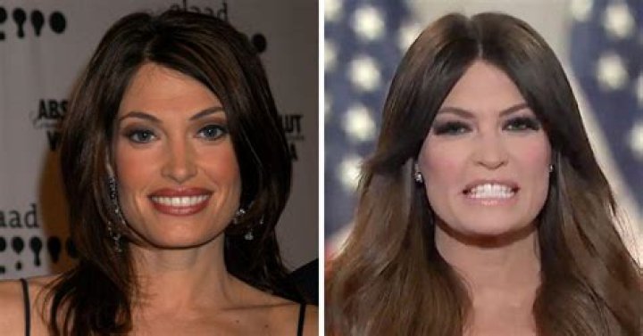 Unveiling The Truth: The Story Behind Kimberly Ann Guilfoyle's Plastic Surgery
